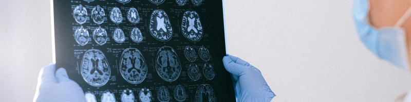 Por que o tratamento do Alzheimer está mudando